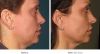 Ultherapy Before and After 3