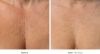 Ultherapy Before and After 2