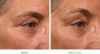 Ultherapy Before and After