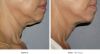Ultherapy Before and After 4