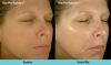 Blue Peel Radiance Before & After