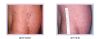 Laser Vein Treatment for Legs Consultation