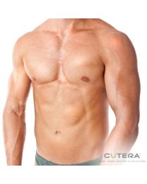 Laser Hair Removal for Men