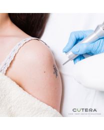 Tattoo Removal