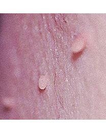 Skin Tag