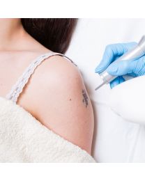 Tattoo Removal