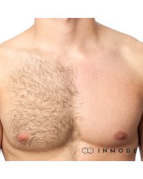 Laser Hair Removal for Male