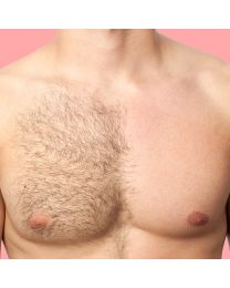 Laser Hair Removal - Men Consultation