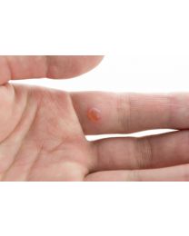 Destruction of Benign Lesion