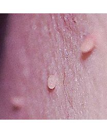 Skin Tag Excision (2 Options)