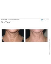 SkinTyte Laser Skin Tightening