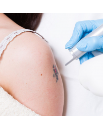 Laser Tattoo Removal Consultation