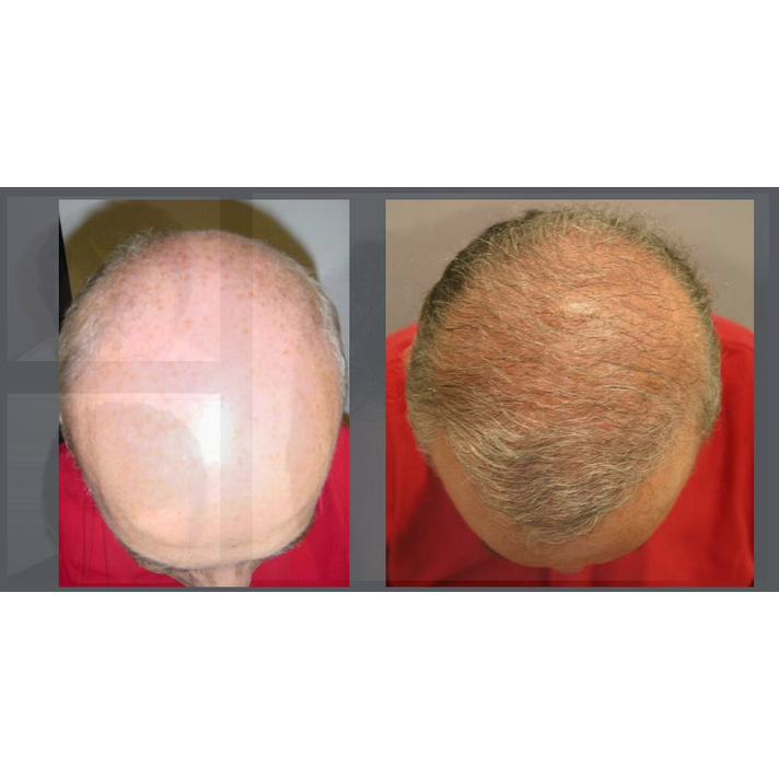 NeoGraft® Automated Hair Transplant System Consultation NeoGraft® Automated Hair Transplant System Consultation