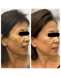 anteage_microneedling_66166