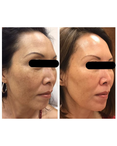 chemical-peel_chemical-peel_66320