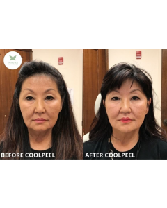 coolpeel_coolpeel_66128