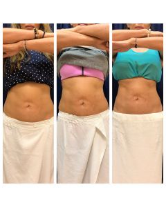 emsculpt_emsculpt_66309