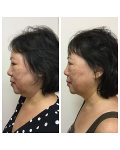 kybella_kybella_66153