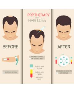 prp-hair-loss-new