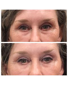 prp_microneedling_66170
