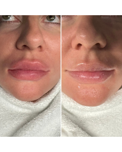 Snow Lips Treatment