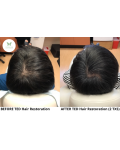 ted-hair-restoration_ted-hair-restoration_66138