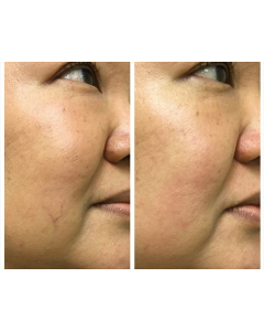 vein-removal_vein-removal_66333