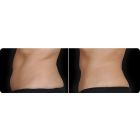 CoolSculpting Before and After 4