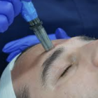 Microneedling