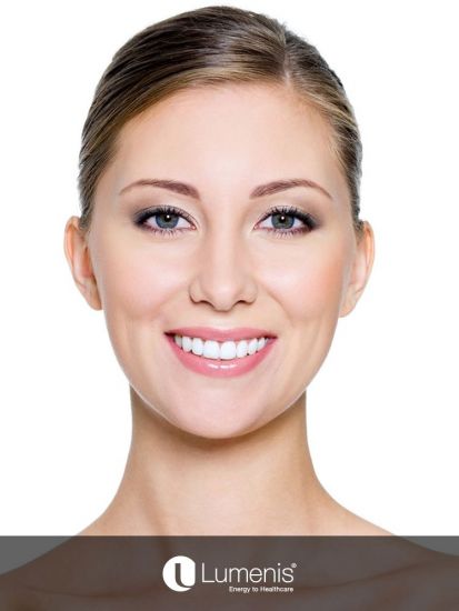 Ultrapulse® Fractional Skin Resurfacing