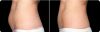 CoolSculpting Before and After 1