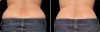 CoolSculpting B&A