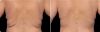 CoolSculpting Before and After 2