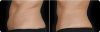 CoolSculpting Before and After 4