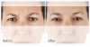 XEOMIN B&A 4