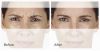 XEOMIN B&A 5