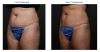 truSculpt® 