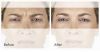 XEOMIN B&A 1