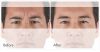 XEOMIN B&A 2