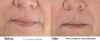 Pearl Treatment Before & After 2