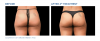 EMSCULPT®