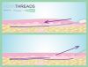 NovaThreads - Absorbable PDO Sutures