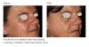 Resurfx before & after 1