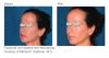 Resurfx before & after 2