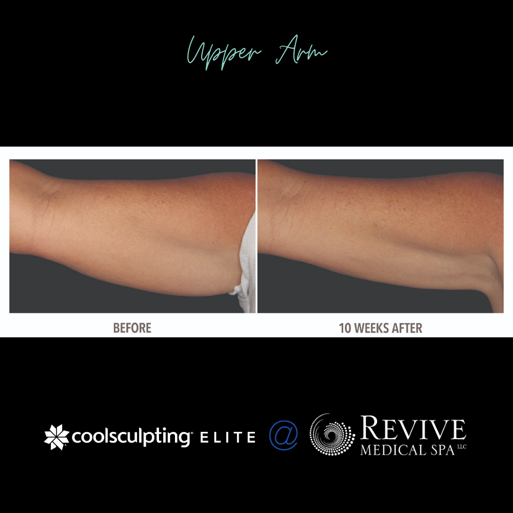 Coolsculpting arms review 2025