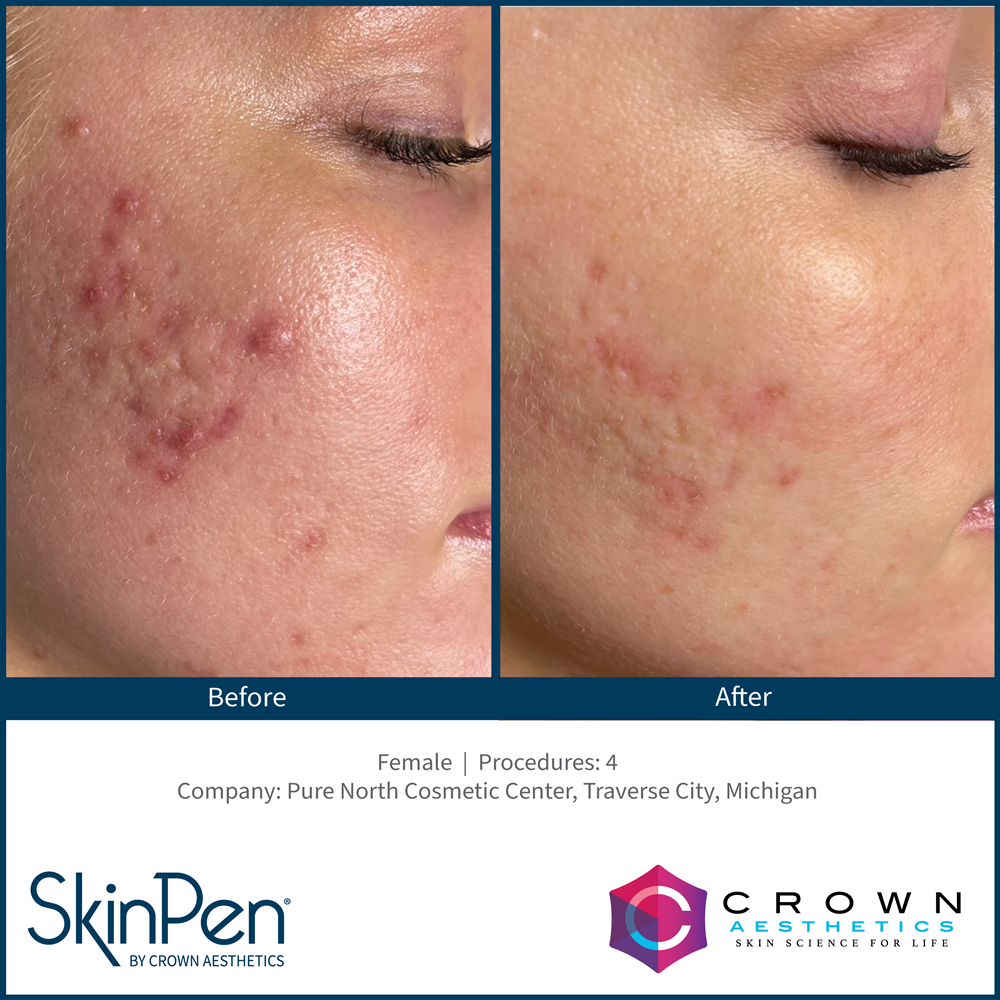 SkinPen® Microneedling Spa on Cuyler
