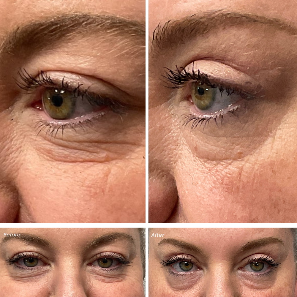 Upper eyelid shop lifter