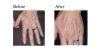 Limelight IPL before and after