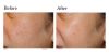 Limelight IPL before and after