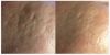 Rejuvapen - Acne Scarring